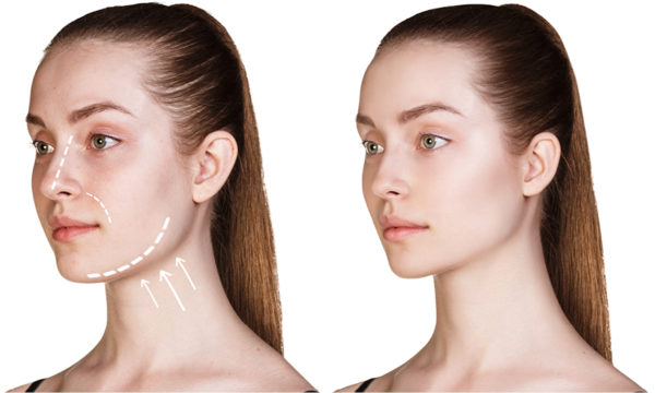 EMATRIX™ Sublative Excellent Wrinkle & Acne Scar Treatment
