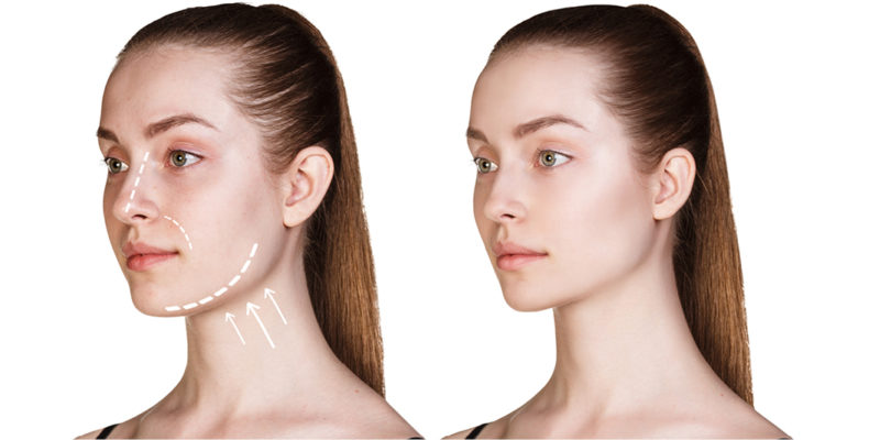 EMATRIX™ Sublative Excellent Wrinkle & Acne Scar Treatment