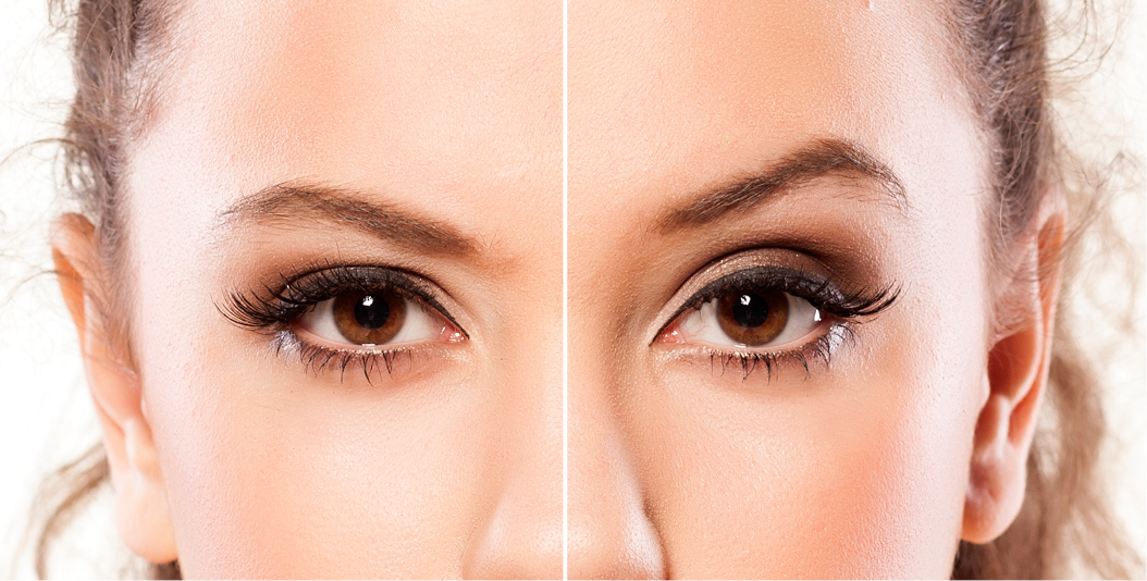 botox eyebrow lift Eyebrow botox brow droopy kaynağı kostenlosestock